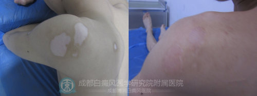 好的成人礼——告别肩背部白癜风